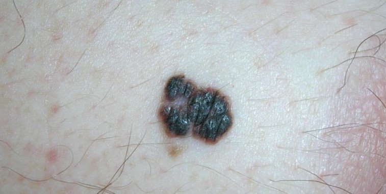 Melanoma