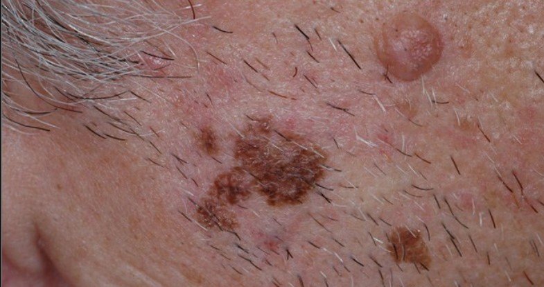 Melanoma uz sejas