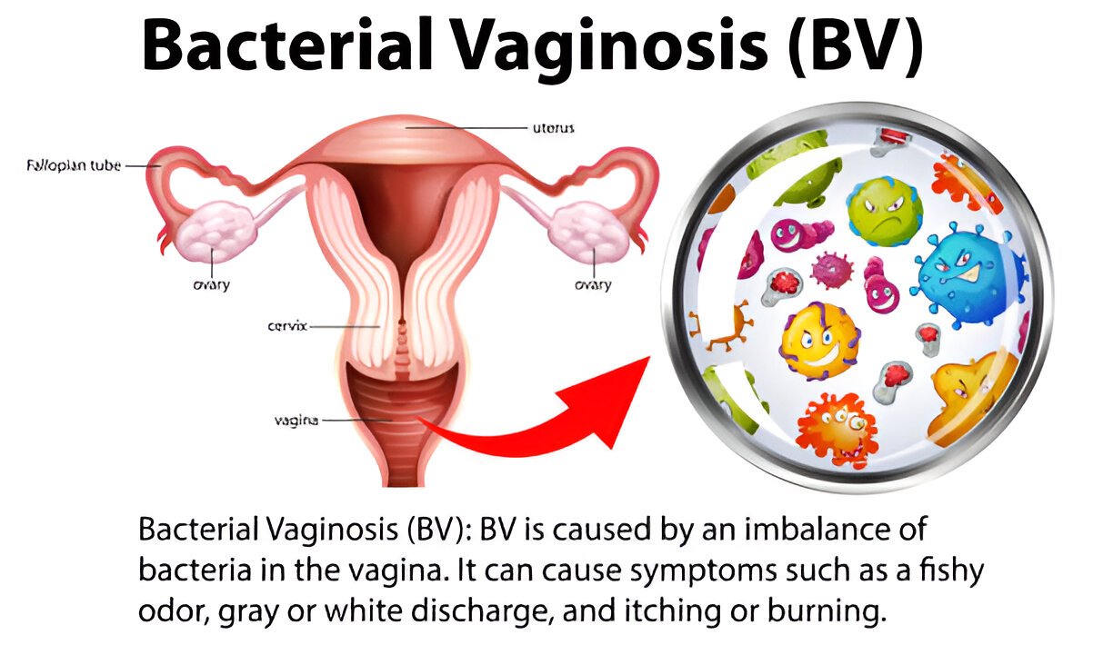 Jums ir bakteriāla vaginoze