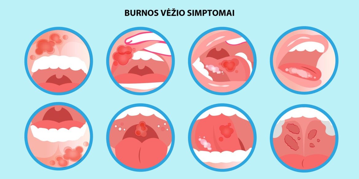 Mutes vēža fakti un simptomi